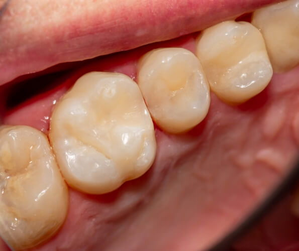 Close up of teeth with barely noticeable fillings