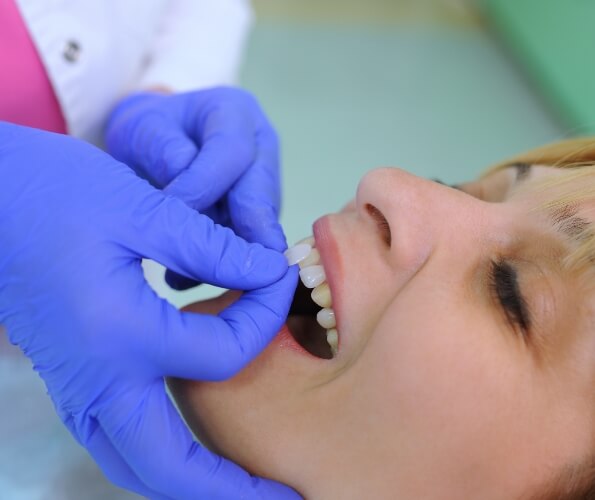 Dentist placing a veneer over a patients front tooth