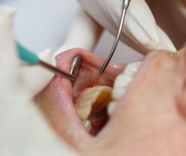 Close up of dentist treating gums with soft tissue laser