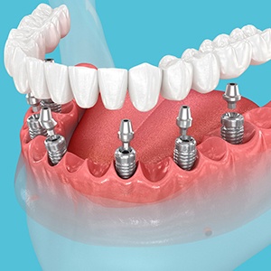 Implant dentures secure to your jaw via a series of dental implant posts