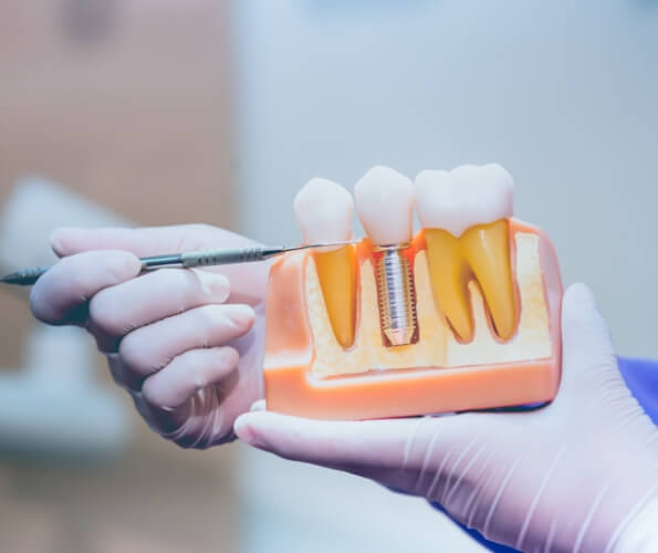Dentist holding a model of the jaw with a dental implant