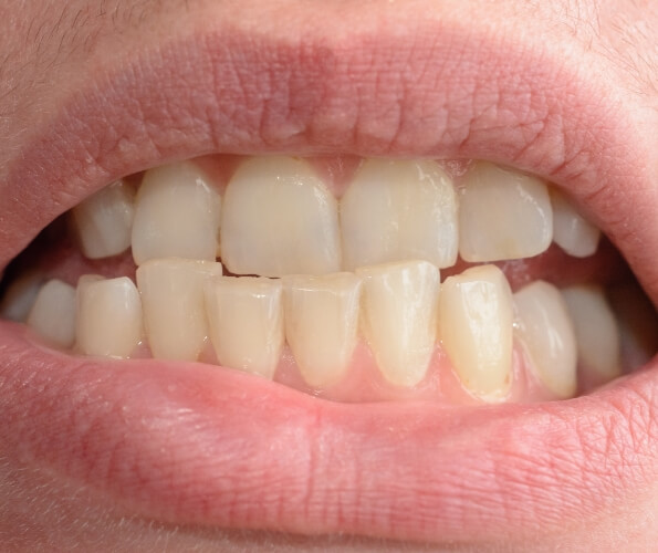 Close up of mouth with slightly misaligned teeth