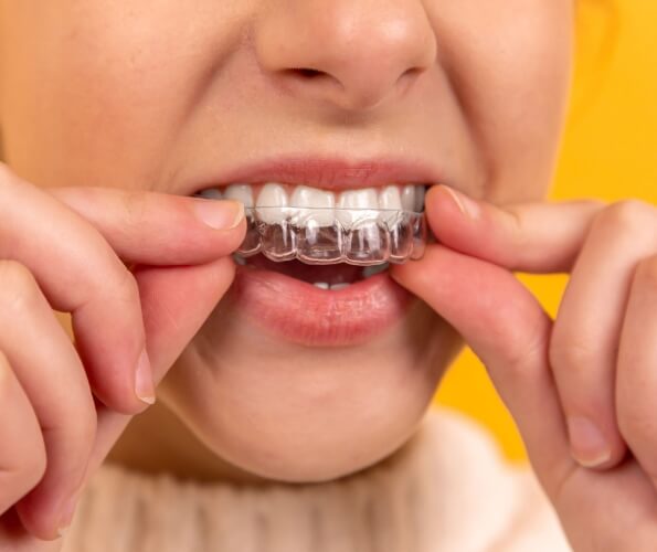 Close up of person placing Invisalign tray over their teeth