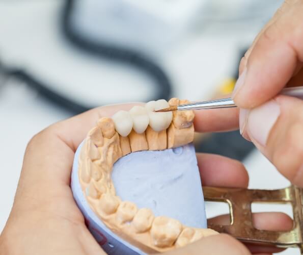 Dentist creating a dental bridge in model of the mouth