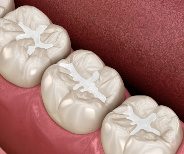 Illustrated row of teeth with dental sealants